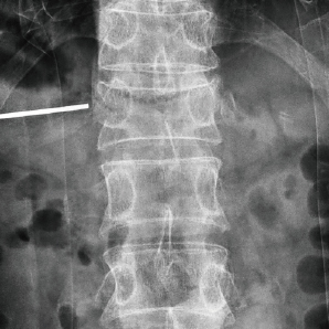 Système de bras C chirurgical avec FPD