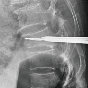 Système de bras C chirurgical avec FPD