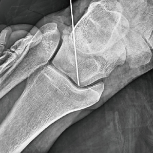 Système de bras C chirurgical avec FPD