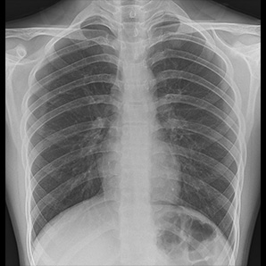 Medical Mobile X-ray System