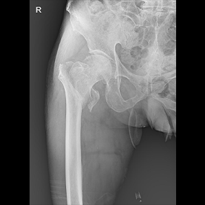 Medical Mobile X-ray System