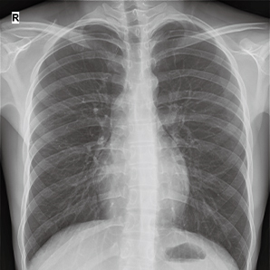 High Frequency Mobile X-ray System