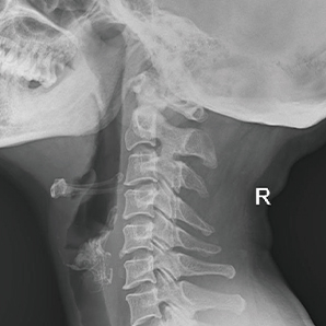 High Frequency Mobile X-ray System
