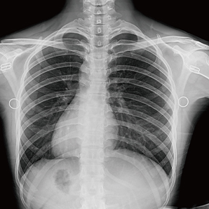 Intelligent Ceiling Suspension Radiographic System