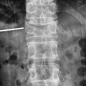 Dernier bras C mobile avec FPD