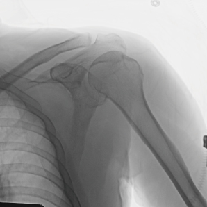 Dernier bras C mobile avec FPD