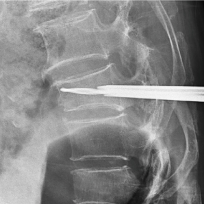 Dernier bras C mobile avec FPD