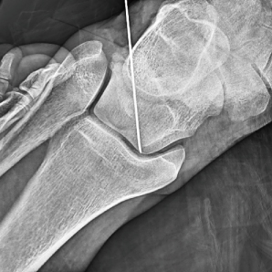 Dernier bras C mobile avec FPD