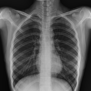 Chest X-Ray with Beatle-01P