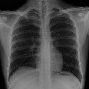 Portable Chest X-Ray Imaging