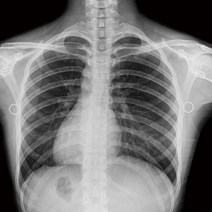 PerfoX 3000 Plus  chest X-ray clinical imaging