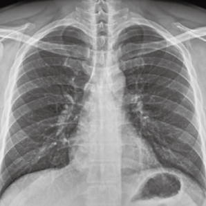 PerfoX 3000 Plus  chest X-ray clinical imaging