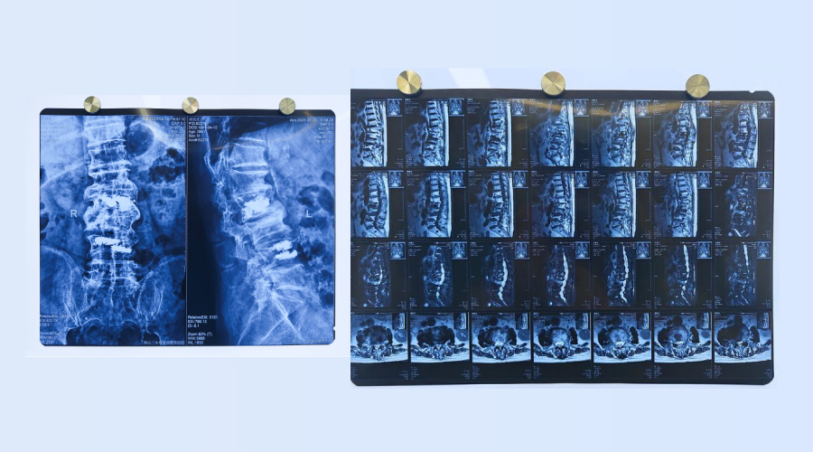 Clinical Application of C-Arm Imaging in Percutaneous Vertebroplasty (PVP)