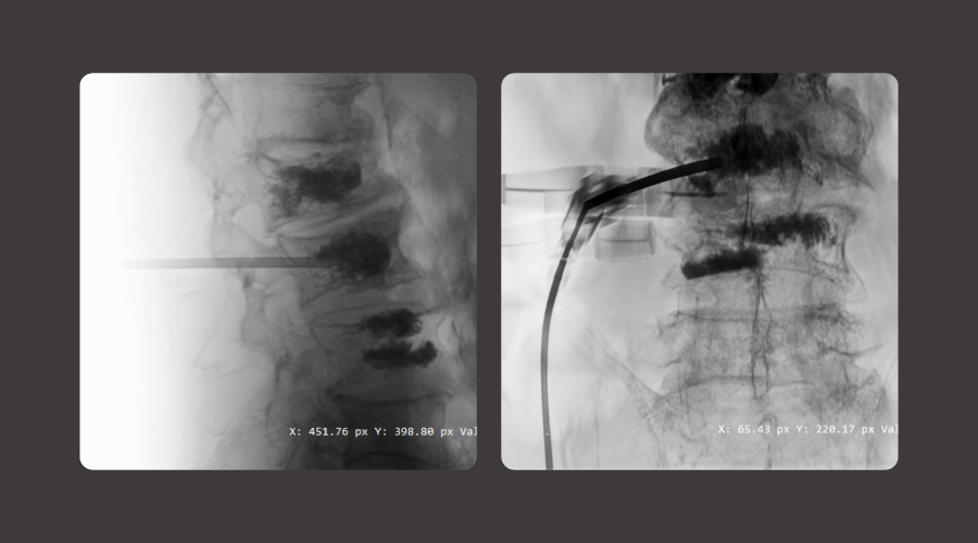 Clinical Application of C-Arm Imaging in Percutaneous Vertebroplasty (PVP)