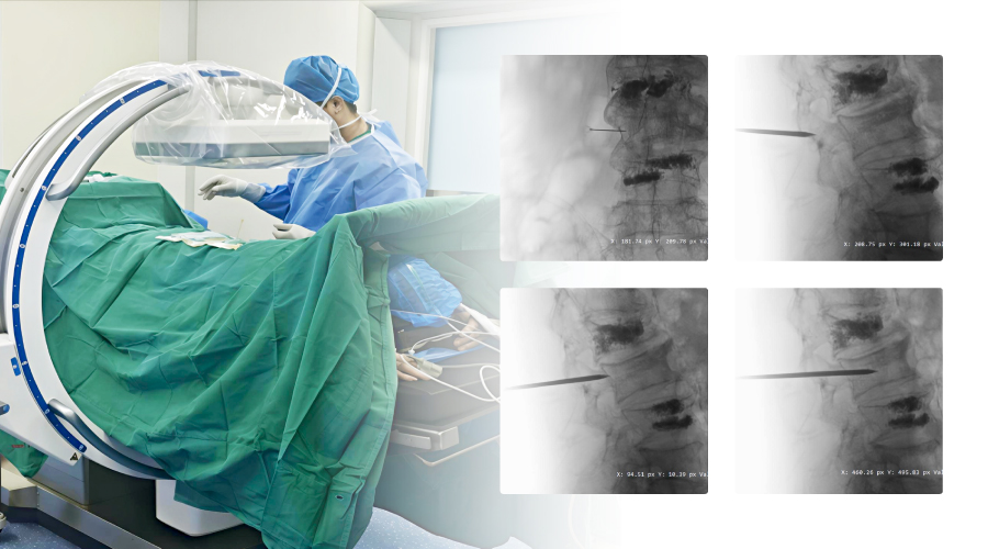 Clinical Application of C-Arm Imaging in Percutaneous Vertebroplasty (PVP)
